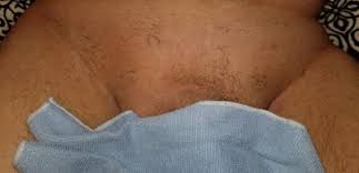 Underarms and bikini since it's coarser hair it's taking time. Male Brazilian Laser Hair Removal Review Realself