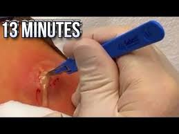 13 Minutes Of Youtube S Best Abscesses What Is An Abscess Youtube