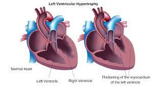 Left Ventricular Hypertrophy Lvh Symptoms Causes And Treatment
