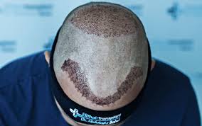 Gonfiore intorno al viso e principalmente intorno agli occhi può capitare raramente per un alcuni giorni post intervento. Prurito Post Trapianto Capelli C E Da Preoccuparsi Elithair