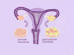 Frauen mit pcos haben zu viele männliche geschlechtshormone. á… Pco Syndrom Ursachen Symptome Diagnose Therapie Cyclotest