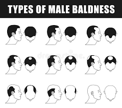 Types Of Male Baldness Stock Vector Illustration Of