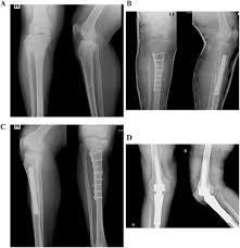 Image result for Osteosarcoma