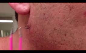 Technicians use a candela gentlemax pro laser to damage the hair follicle and stop hair regrowth. This Guy Has The Most Insane Ingrown Hair You Ve Ever Seen