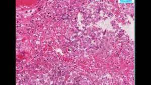 Histology was available for 18 patients and showed evidence of granulation tissue, fibrosis, and aim: Histopathology Lung Aspergillosis Youtube