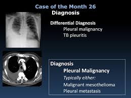 Mesothelioma of the tunica vaginalis of the testis is an exceptionally rare. Case Of The Month 26 August Ppt Download