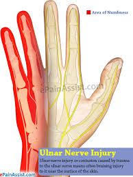 Ulnar Nerve Injuries Ulnar Nerve Ulnar Nerve Entrapment Nerve Entrapment