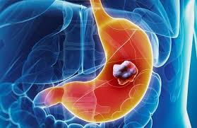 �pain or bloating in the stomach after you eat. Affordable Stomach Cancer Treatment Cost In India Vaidam Com