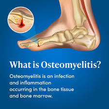 Image result for Osteomyelitis