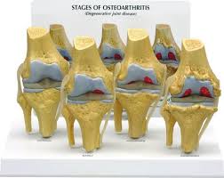 Je vous explique ici pourquoi ça marche. 4 Stades De L Arthrose Du Genou Physiosupplies