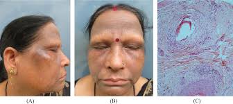 No hair follicle openings can be seen in the areas of hair loss. Lichen Planus Pigmentosus And Frontal Fibrosing Alopecia The Link Explored Raihan A Kumaran Ms Pigment Int