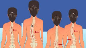 Vertebre) ber fungsi menyangga berat tubuh. Ketahui Jenis Jenis Skoliosis Atau Kelainan Tulang Belakang