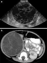 Multilocular Cystic Renal Tumor Renal Radiology Kidney Tumor