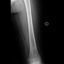 Image result for Ewing Sarcoma