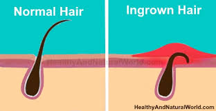 Apply an ingrown hair treatment immediately after like (malin + goetz) ingrown hair cream, which uses glycolic and salicylic acids to prevent and heal bumps. How To Get Rid Of Ingrown Hair On Head Natural Ways That Really Work