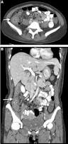 Image result for Neutropenic Colitis
