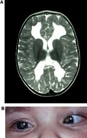As this commences, finding and treating the underlying cause is essential. Purpura Fulminans Recognition Diagnosis And Management Archives Of Disease In Childhood