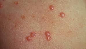 Maybe you would like to learn more about one of these? Virusutslag Utslag Orsakat Av Ett Virus Kry