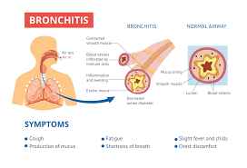 Image result for Acute Bronchitis