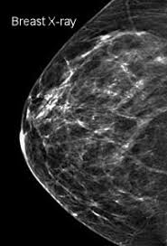 How do they know if a lump is worrisome? Common Mammogram Findings Moose And Doc