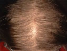 While less hair is often the only sign of hair loss, some people develop symptoms and other signs. Female Pattern Hair Loss Dermnet Nz