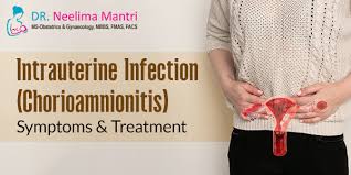 Image result for Chorioamnionitis