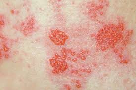 Image result for shingles in children