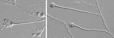 Invasive aspergillosis (ia) is a severe infection that occurs in patients with prolonged neutropenia, following transplantation or in conjunction with aggressive immunosuppressive regimens (eg, prolonged corticosteroid usage, chemotherapy). Invasive Aspergillose Nrzmyk Nationales Referenzzentrum Fur Invasive Pilzinfektionen