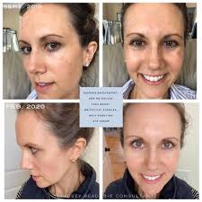 Melasma, known as the “Mask of Pregnancy” does not only occur in pregnant  women, but it can occur in all sorts of skin types, men and women. Learn  more