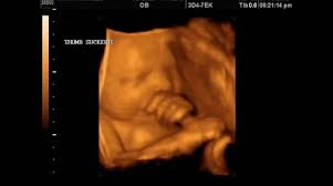 Helps determine the baby's due date; Ultrasound Stock Video Footage Royalty Free Ultrasound Videos Pond5