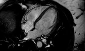 Über verschiedene ankopplungspunkte kann mittels sonografie die funktionsfähigkeit der herzklappen beurteilt werden und mittels vermessung die größe der hohlräume und somit eventuelle dilatationen ermittelt oder die dicke bestimmter strukturen vermessen werden. Myokarditis Nach Corona Infektion Wichtiges Puzzleteil Entdeckt