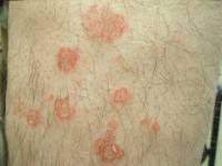 Image result for Eczema nummulare