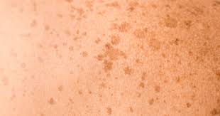 Image result for Solar Lentigo