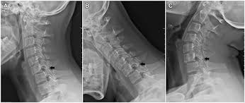 Capsule and synovial folds of the facet joint of the lumbar spine are richly innervated. Posterior Unlocking Of Facet Joints Under Endoscopy Followed By Anterior Decompression Reduction And Fixation Of Old Subaxial Cervical Facet Dislocations A Technical Note Sciencedirect