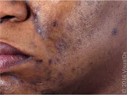 Image result for Diffuse Hyperpigmentation