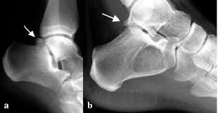 Lateral Radiographs In Posterior Impingement A Os Trigonum Download Scientific Diagram