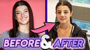 Charli D Amelio Before After 2020 Nose Job Youtube