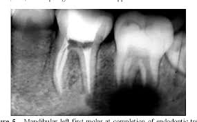 Image result for periostitis