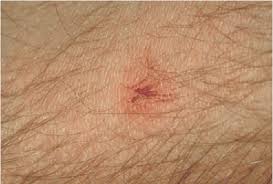 Laser hair removal has become popular these days. Figure 5 From Laser Hair Removal A Review Semantic Scholar