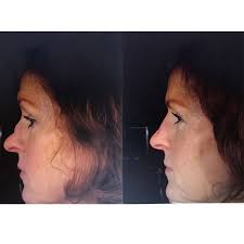 Rhinoplasty