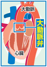 【心臓手術】 大動脈弁狭窄症 大動脈弁置換術 弁膜症 aortic valve replacement for aortic stenosis 【俺に切らせろ!】 大動脈弁置換術は心臓手術の中でも早い段階で習得する手術の一つです。しかしながら大動脈弁狭窄. Lhnmlutcopangm