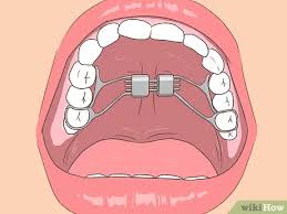 Braces are used to correct mild to severe cases of underbites by moving the teeth into their proper alignment. 3 Ways To Fix An Underbite Wikihow