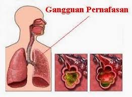 Rs Lira Medika 10 Macam Penyakit Pernapasan Beserta Penyebab Pengobatan Dan Pencegahannya