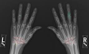 Image result for XRay Changes in Rheumatic Conditions