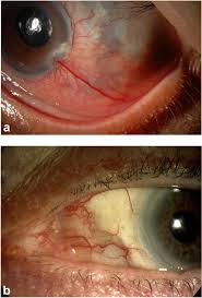 Image result for Scleritis
