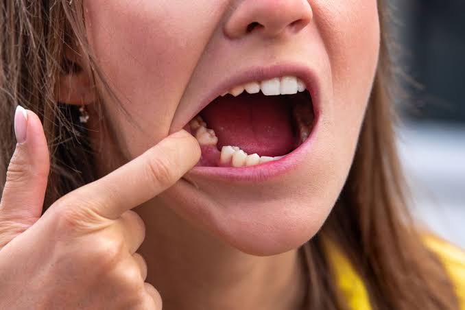 5 Options to Replace a Missing Tooth Without an Implant