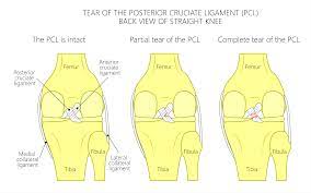 Grade 2 usually means partial tearing of the ligaments in the ankle. What Is The Difference Between An Acl Sprain And Tear Athletico