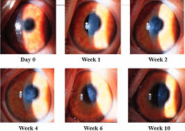 Atlas Entry - Subepithelial Corneal Haze After Herpes Zoster Virus (Hzv)  Keratitis