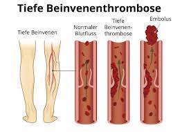 Tiefe Beinvenenthrombose Symptome Ursachen Verlauf