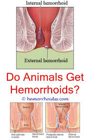 Pin On How Long Do Hemorrhoids Last